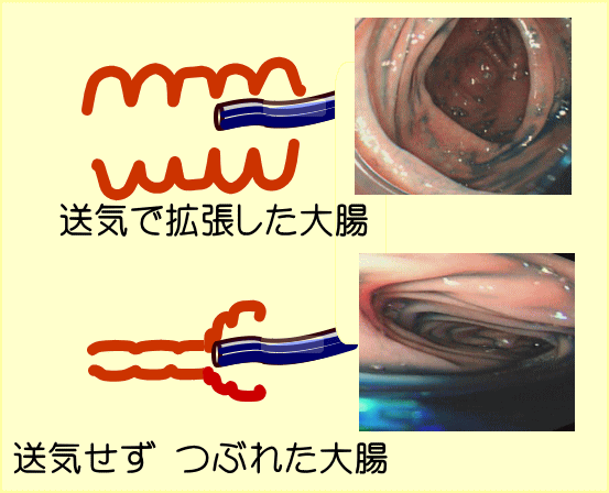 大腸カメラ 拡大内視鏡　本庄市 児玉郡医師会 